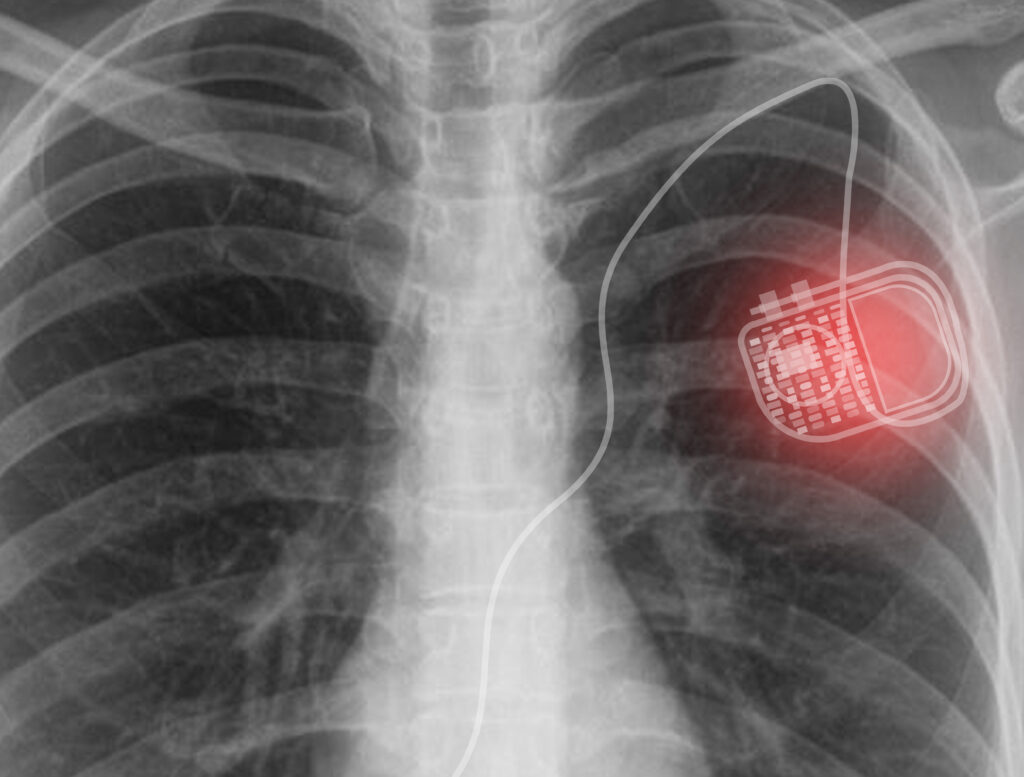 X-ray of a Pacemaker inside someone's chest